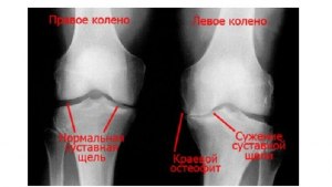 При артрозе суставов нужно больше двигаться или лежать? почему?