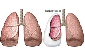 Что такое пневмоторекс?