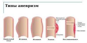 Чем псевдоаневризма отличается от аневризмы?