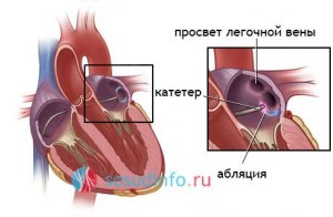 Почему через 2, 5 месяца после операции на сердце , появилась аритмия?