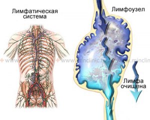 Нарушение оттока лимфы - как называется болезнь? Симптомы? Последствия?