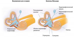 Что такое болезнь Меньера цереброваскулярного происхождения?