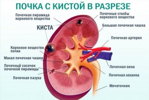 Поможет ли почечный сбор, если почка сужена?