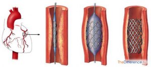 Чем аорто-коронарное шунтирование отличается от стентирования?
