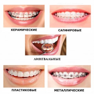 Почему в последнее время стали модными брекеты?