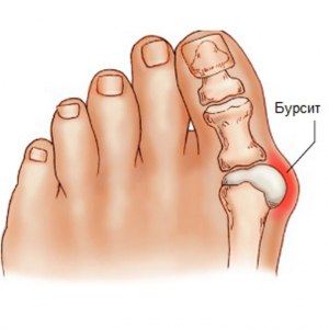 Что такое бурсит и почему движение приносит страдания, как лечат и кто?