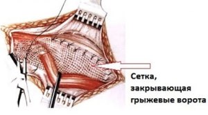 Какие последствия для организма после операции по удалению паховой грыжи?