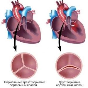 Не дозакрывается клапан сердца. Это опасно?