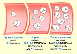 Какие ощущения у человека при повышении сахара в крови?