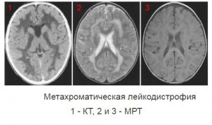 Что такое лейкодистрофия?