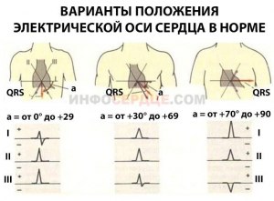 Смещение эл. оси сердца влево- что за патология, чем опасна?