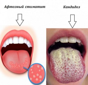 Какой врач лечит кандидоз полости рта?