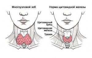 Статины и узлы щитовидной железы, есть противопоказания?